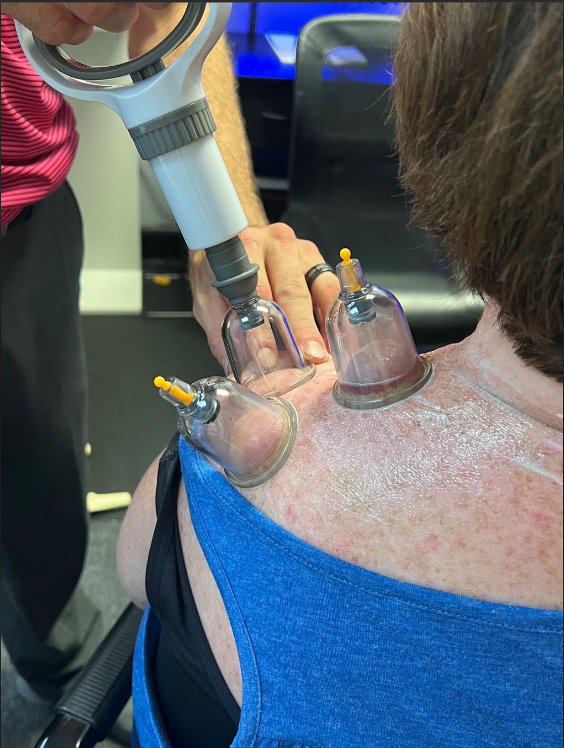 Cupping therapy in north myrtle beach